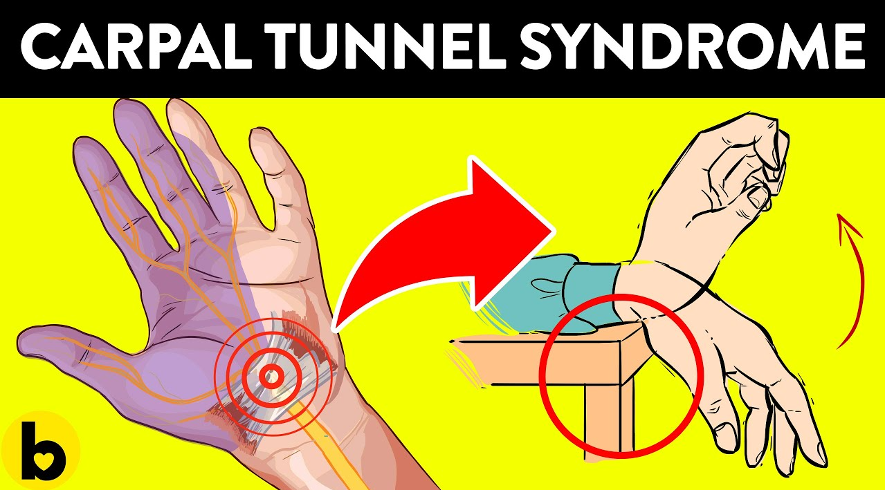 13 วิธีที่มีประสิทธิภาพในการเอาชนะ Carpal Tunnel Syndrome